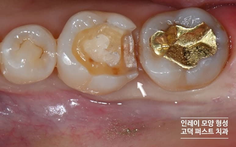 기존 인레이 제거 및 모양 형성