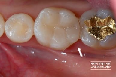 새 세라믹 인레이 장착 완료