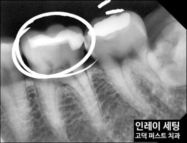 치료 후 엑스레이 확인
