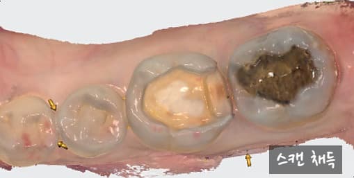 트리오스5 구강 스캔 채득