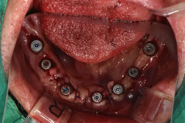무절개 임플란트 수술
