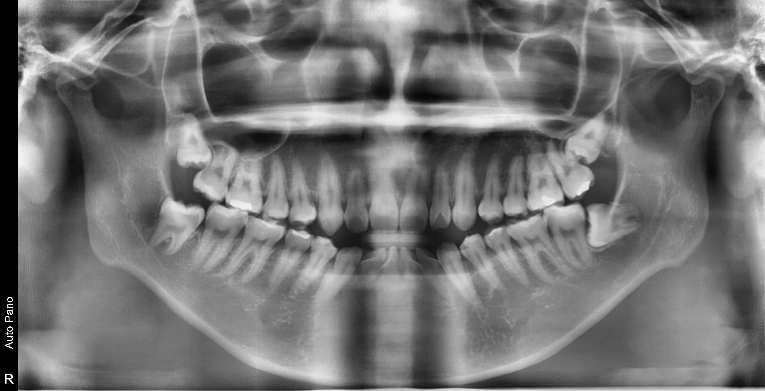 치근만곡 사랑니 - 발치 전